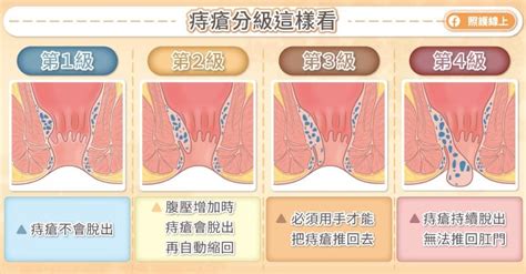 內外痣|痔瘡會自已好嗎？怎麼推回去？出血、血栓...症狀有哪。